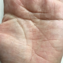 dyshidrotic hand blister
