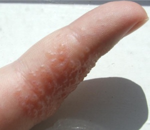 Dyshidrotic finger blisters