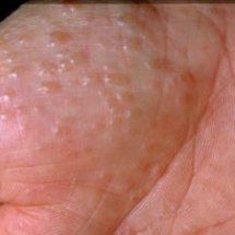 3529-pompholyx-eczema-compressed-300x225